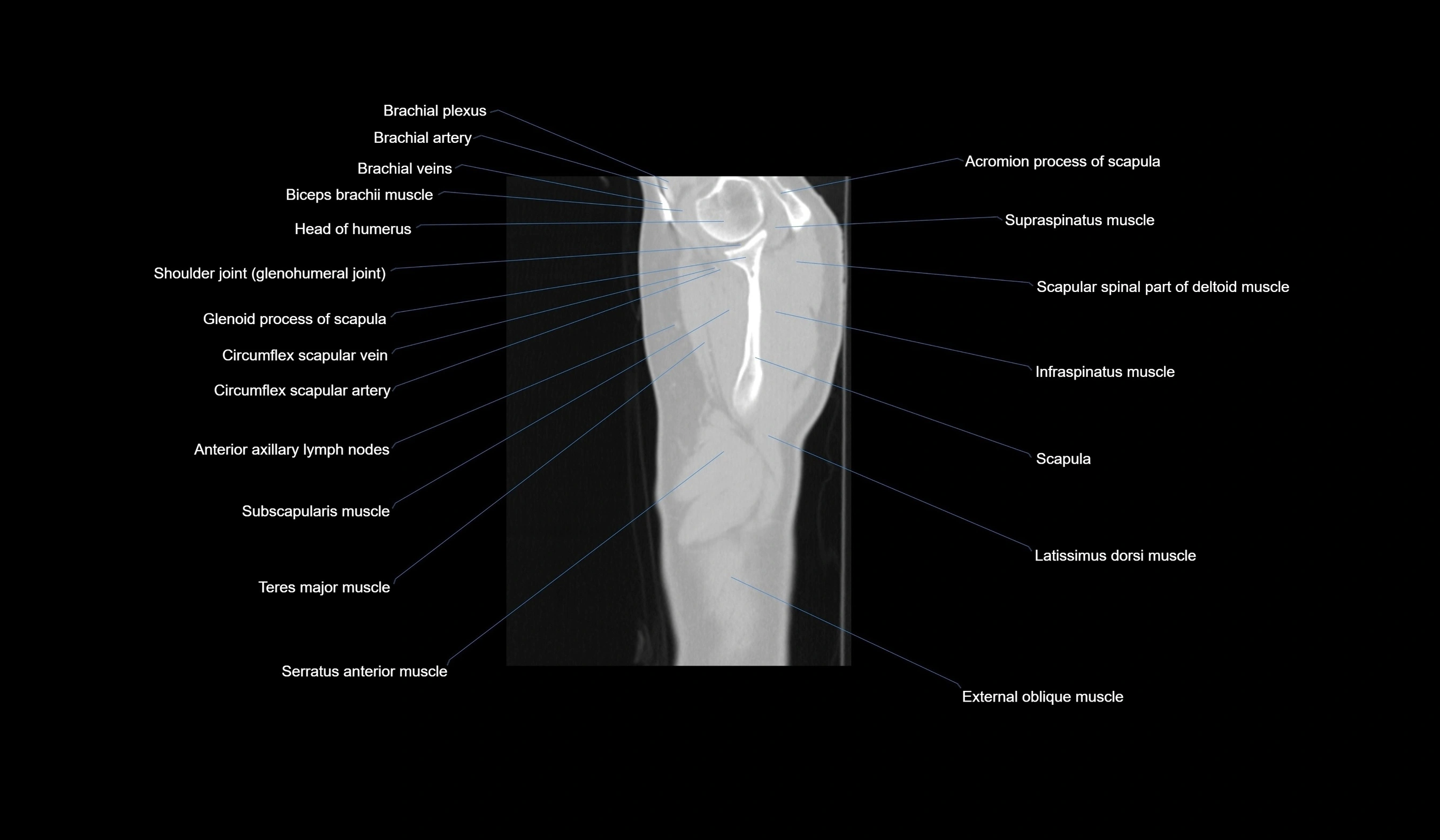 CT chest (thorax) labelled sagittal cross sectional anatomy radiology image-00010.webp